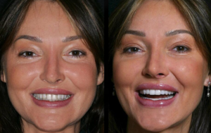 Beverly hills cosmetic dental care