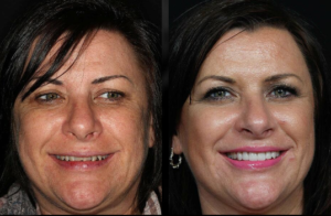 Beverly hills cosmetic dental care