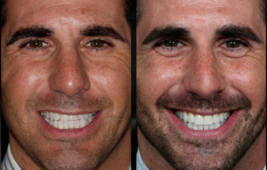 Beverly hills cosmetic dental care