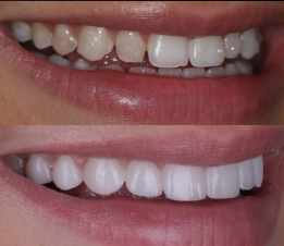 Beverly hills cosmetic dental care