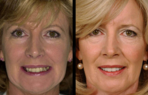 Beverly hills cosmetic dental care