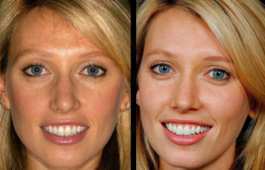 Beverly hills cosmetic dental care