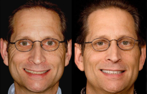 Beverly hills cosmetic dental care