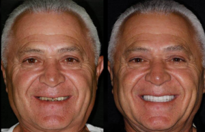 Beverly hills cosmetic dental care