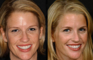 Beverly hills cosmetic dental care