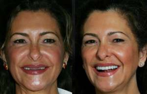 Beverly hills cosmetic dental care