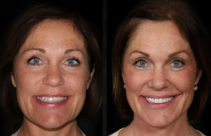 Beverly hills cosmetic dental care