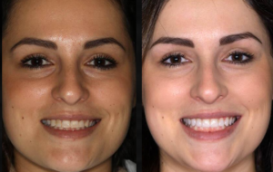 Beverly hills cosmetic dental care