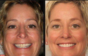 Beverly hills cosmetic dental care
