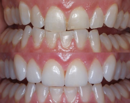 Beverly hills cosmetic dental care