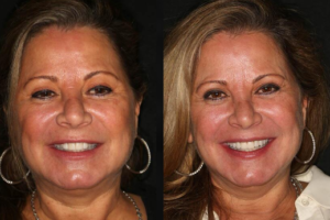 Beverly hills cosmetic dental care