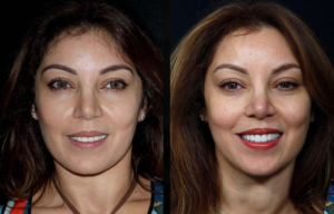 Beverly hills cosmetic dental care