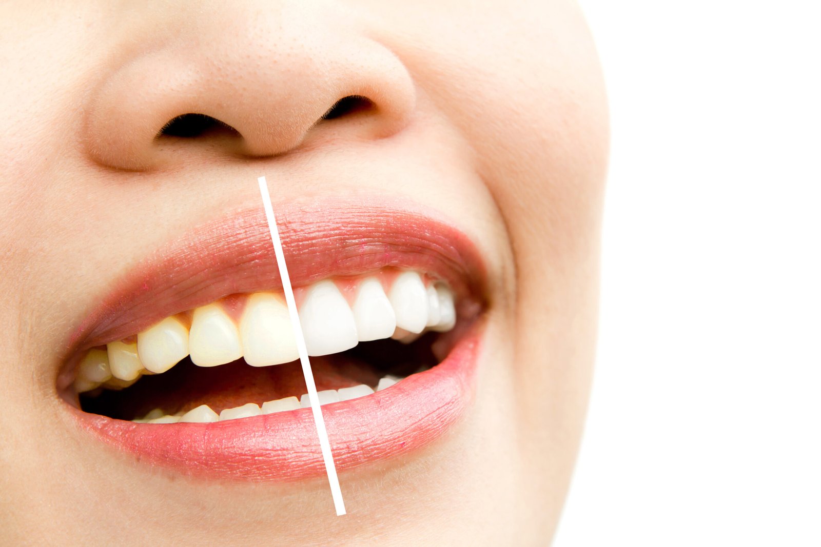 Before-after image of a smile, showing yellowed teeth on one side and whiter teeth on the other, illustrating Whiter Teeth Without Expensive Treatments in Brentwood.