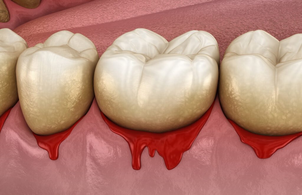 Why gums bleed in Brentwood
