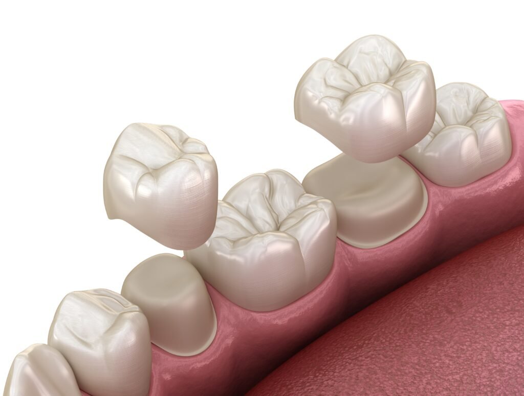 Dental Crown in Brentwood