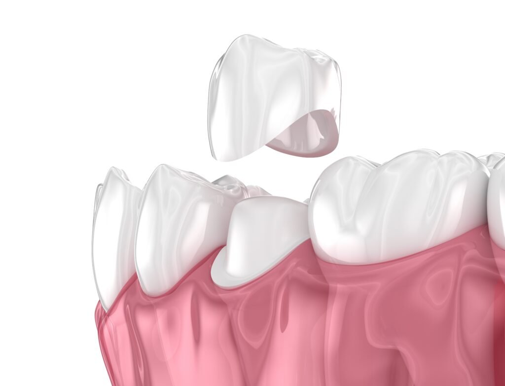 Dental Crown in Brentwood