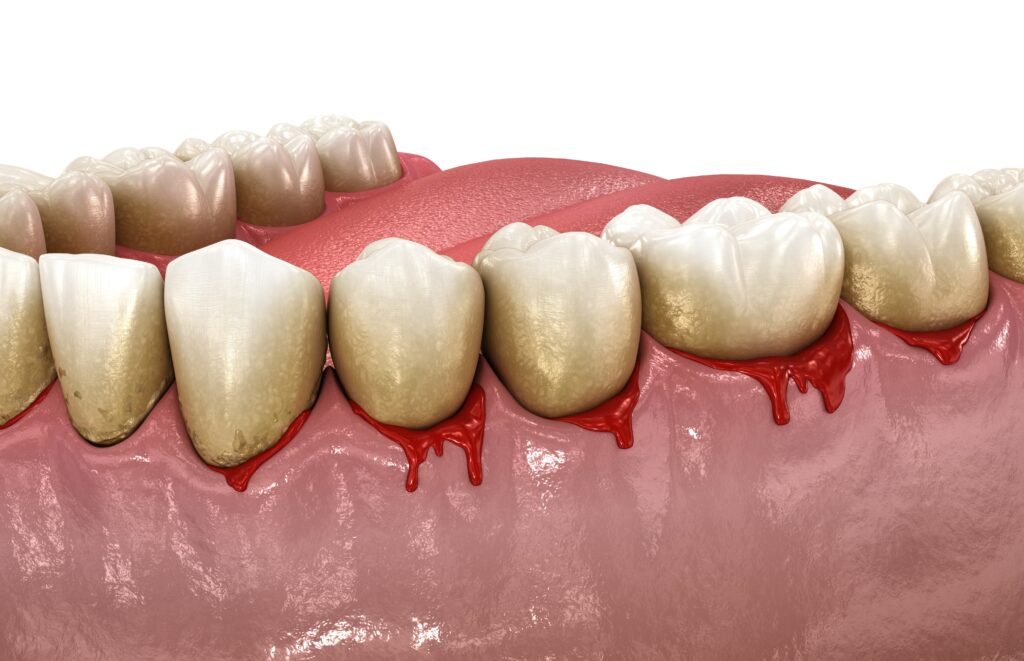 Why gums bleed in Brentwood