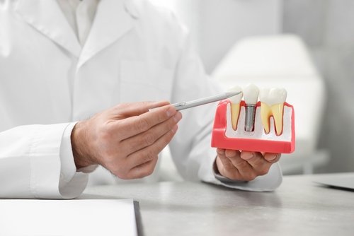 Dental Implants